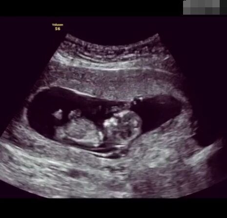 胎儿背对妈妈B超图图片